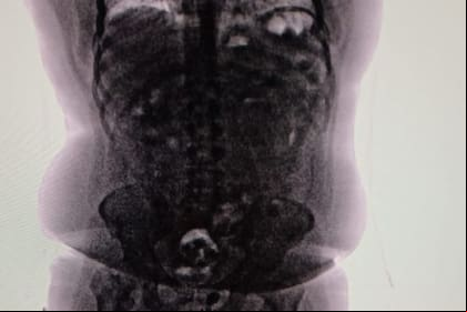 Así veía el cuerpo de la "mula" en el escáner