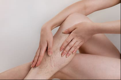 The concept of varicose disease and cosmetology. The woman sits cross-legged with varicose veins in her knees and rubs her skin with her palms. Copy space